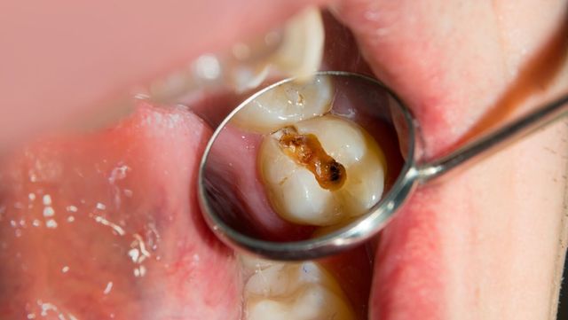 歯を削らない治療・歯を抜かない治療なら香川県 高松市 薬で治す歯科治療の吉本歯科医院
