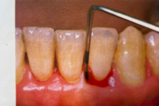 歯茎が下がる原因と治療法|高松市のかみあわせ専門の吉本歯科医院